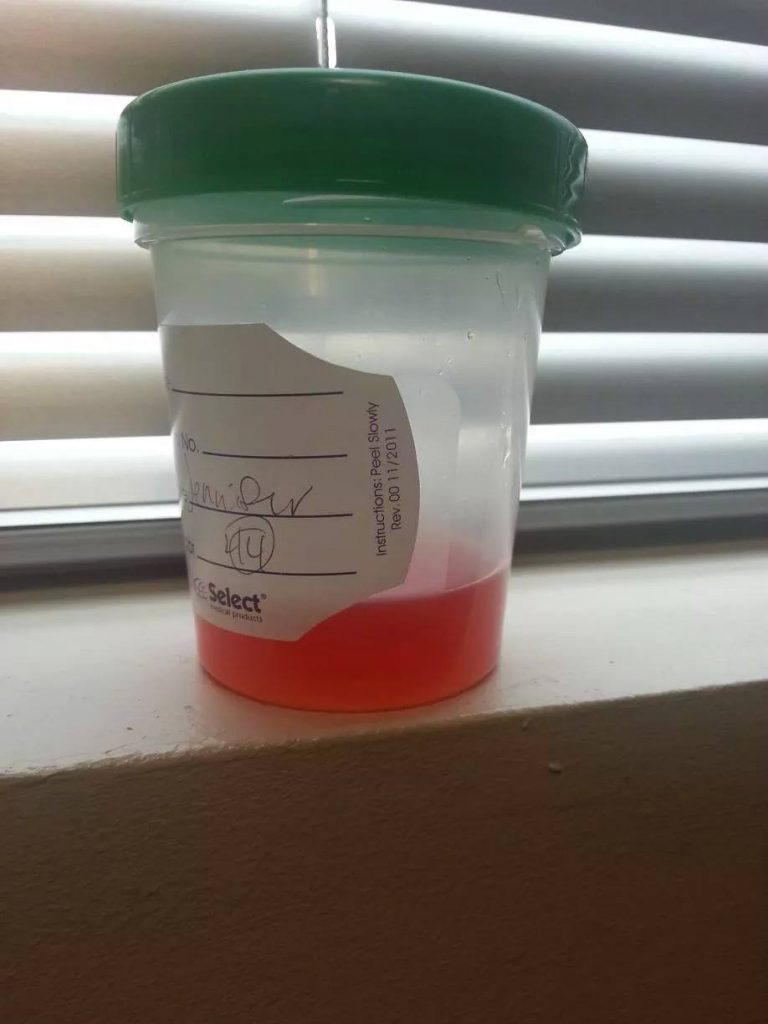 Loin Pain Hematuria Syndrome causes blood in urine